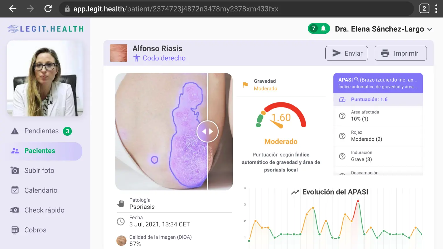 PASI Psoriasis